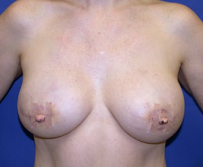 Breast Reconstruction TRAM Before & After Gallery - Patient 178638 - Image 2