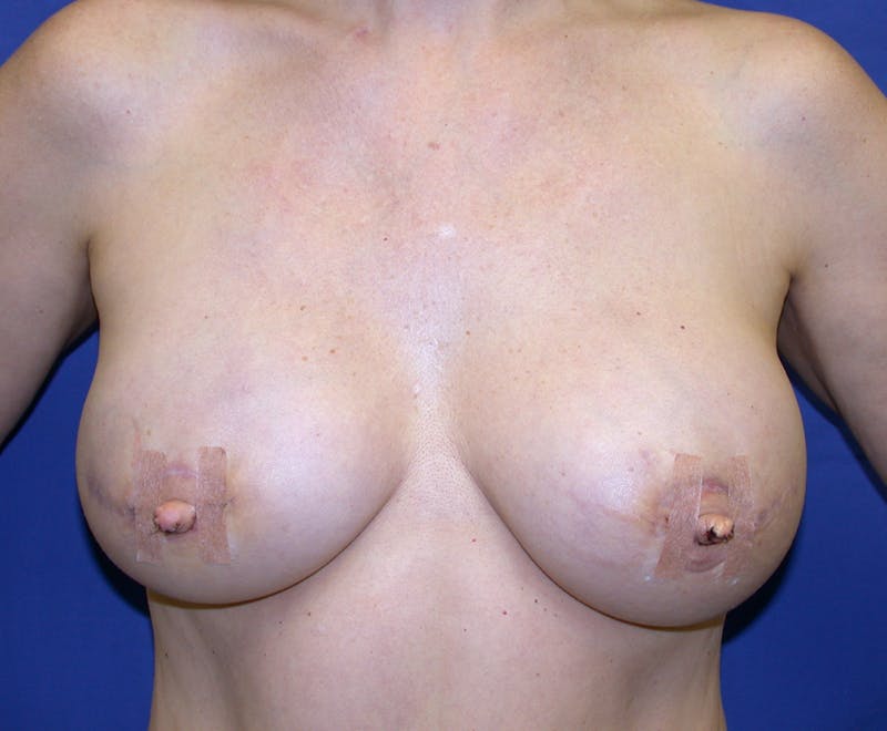 Breast Reconstruction TRAM Before & After Gallery - Patient 178638 - Image 2