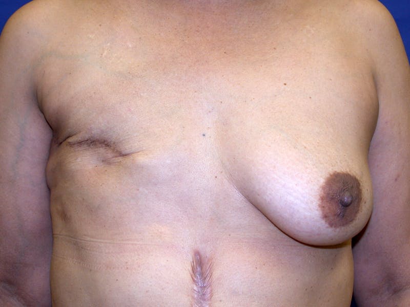 Breast Reconstruction TRAM Before & After Gallery - Patient 238657 - Image 1