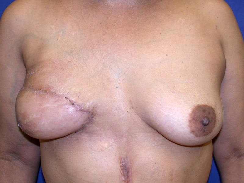 Breast Reconstruction TRAM Before & After Gallery - Patient 238657 - Image 2