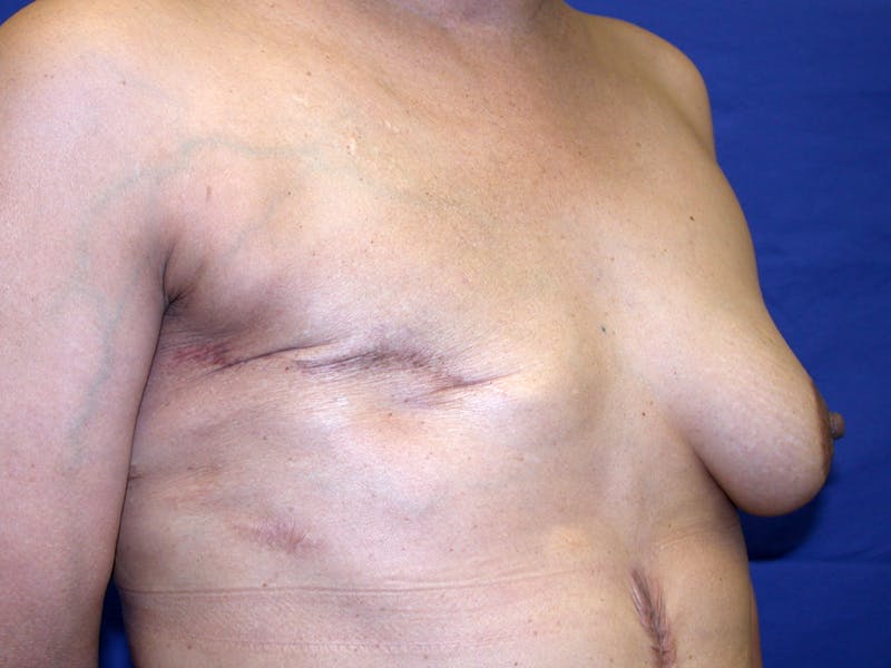 Breast Reconstruction TRAM Before & After Gallery - Patient 238657 - Image 3