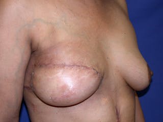 Breast Reconstruction TRAM Before & After Gallery - Patient 238657 - Image 4
