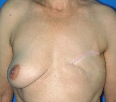 Breast Reconstruction TRAM Before & After Gallery - Patient 111497 - Image 1