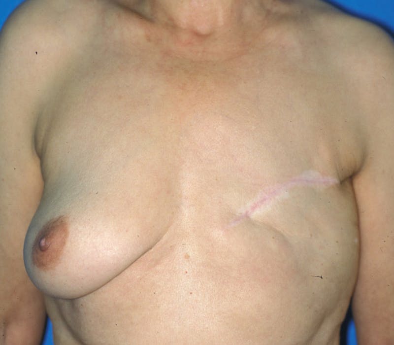 Breast Reconstruction TRAM Before & After Gallery - Patient 111497 - Image 1