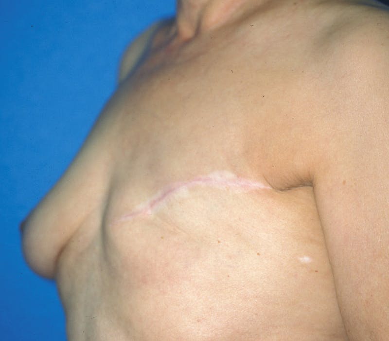 Breast Reconstruction TRAM Before & After Gallery - Patient 111497 - Image 3