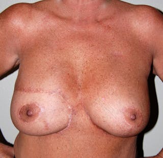 Breast Reconstruction TRAM Before & After Gallery - Patient 114971 - Image 2