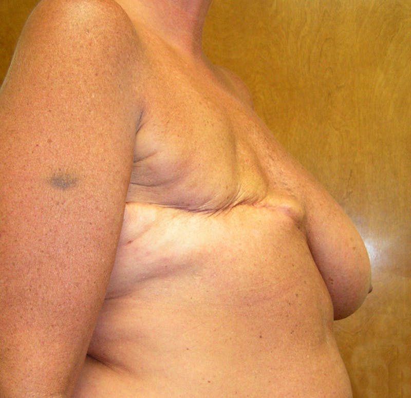 Breast Reconstruction TRAM Before & After Gallery - Patient 114971 - Image 3