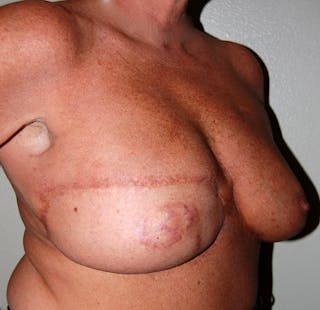 Breast Reconstruction TRAM Before & After Gallery - Patient 114971 - Image 4