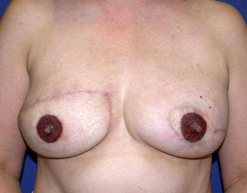Breast Reconstruction TRAM Before & After Gallery - Patient 143066 - Image 2