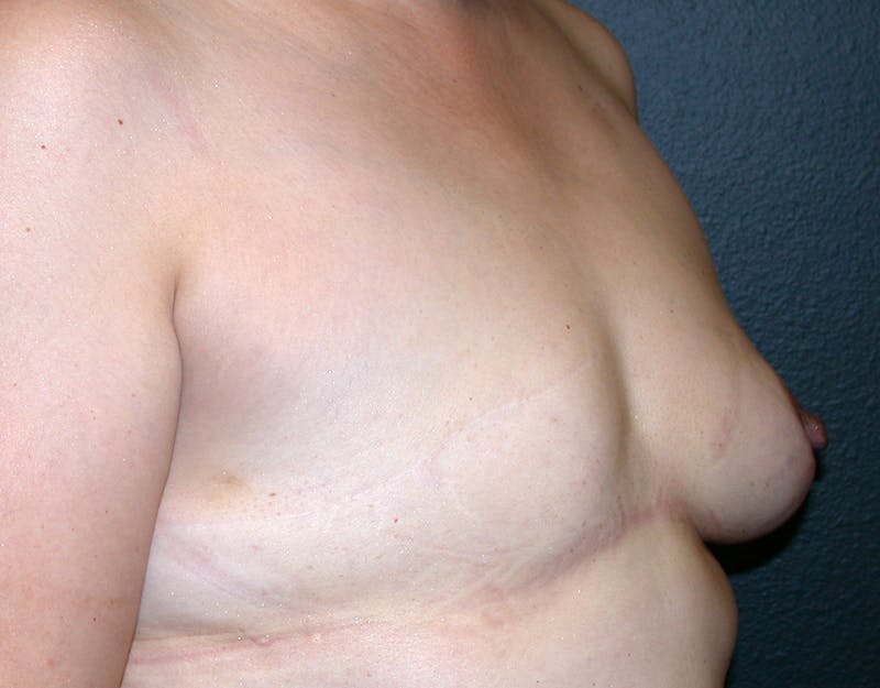 Breast Reconstruction TRAM Before & After Gallery - Patient 143066 - Image 3