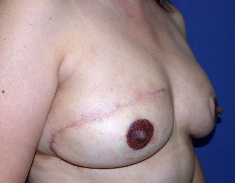 Breast Reconstruction TRAM Before & After Gallery - Patient 143066 - Image 4