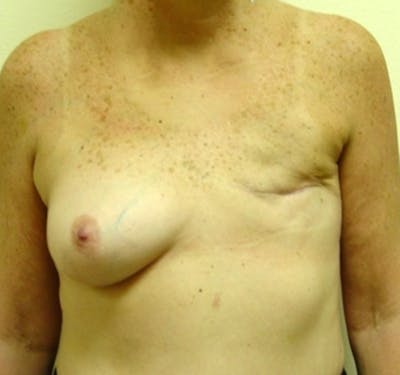 Breast Reconstruction TRAM Before & After Gallery - Patient 141167 - Image 1