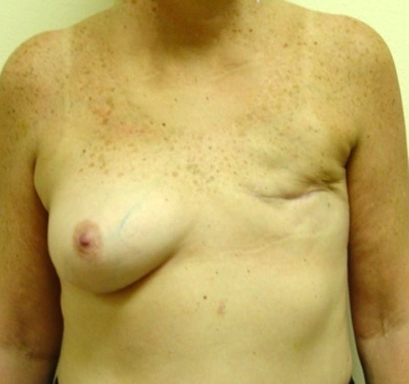 Breast Reconstruction TRAM Before & After Gallery - Patient 141167 - Image 1