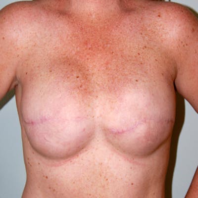 Nipple Reconstruction Before & After Gallery - Patient 418651 - Image 1