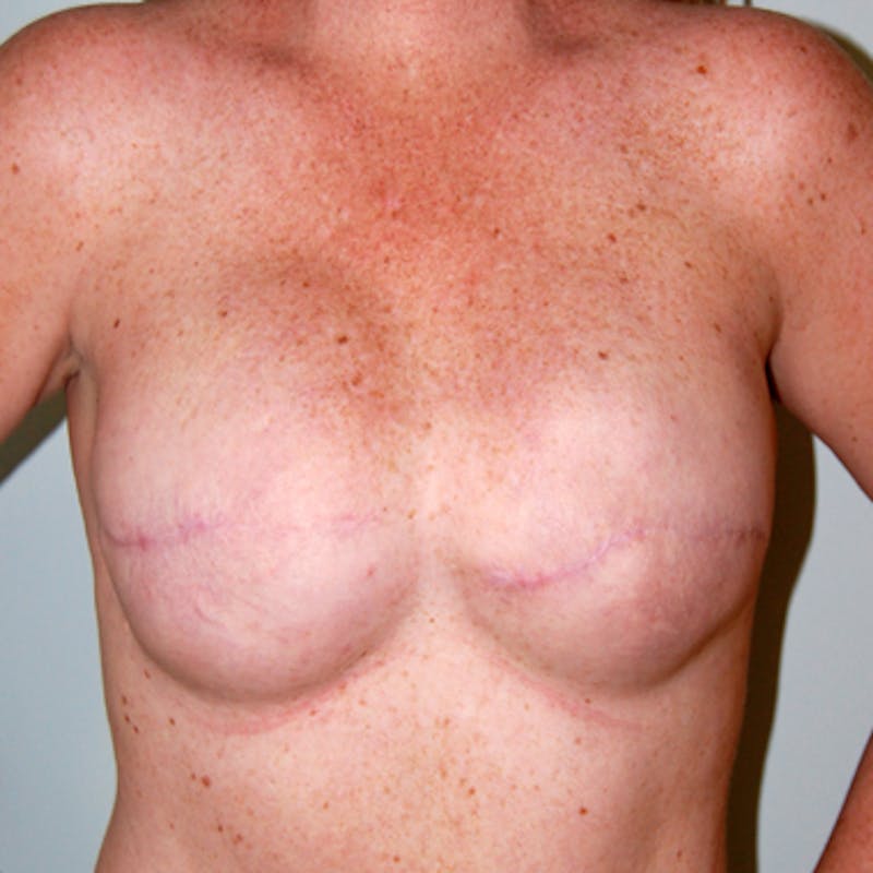 Nipple Reconstruction Before & After Gallery - Patient 418651 - Image 1