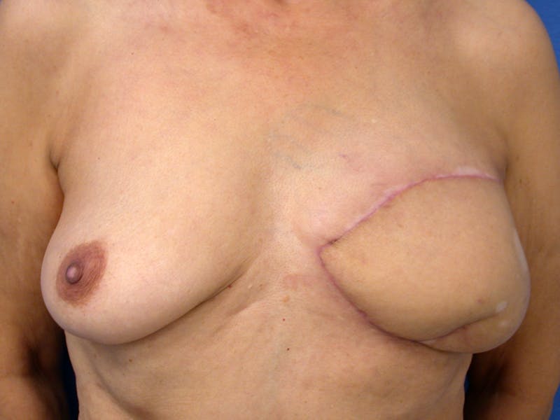 Nipple Reconstruction Before & After Gallery - Patient 238116 - Image 1