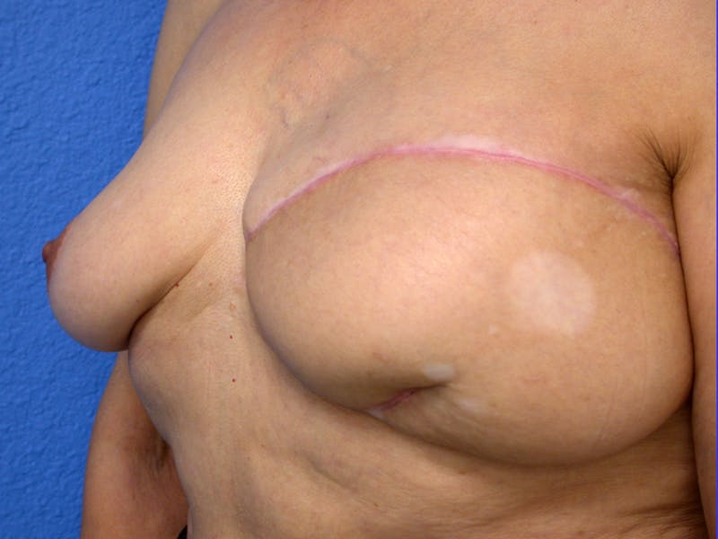 Nipple Reconstruction Before & After Gallery - Patient 238116 - Image 3