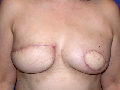 Nipple Reconstruction Before & After Gallery - Patient 212702 - Image 1