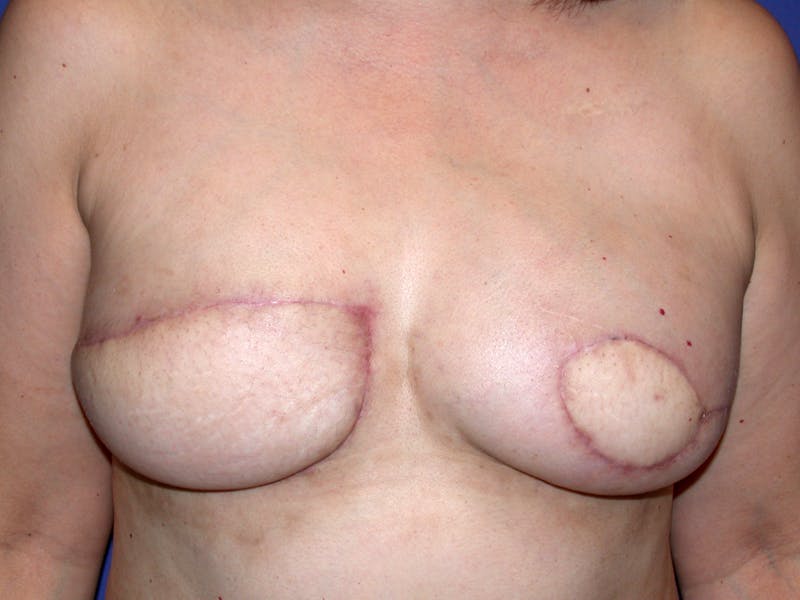 Nipple Reconstruction Before & After Gallery - Patient 212702 - Image 1