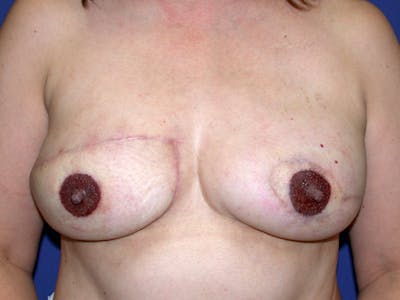 Nipple Reconstruction Before & After Gallery - Patient 212702 - Image 2