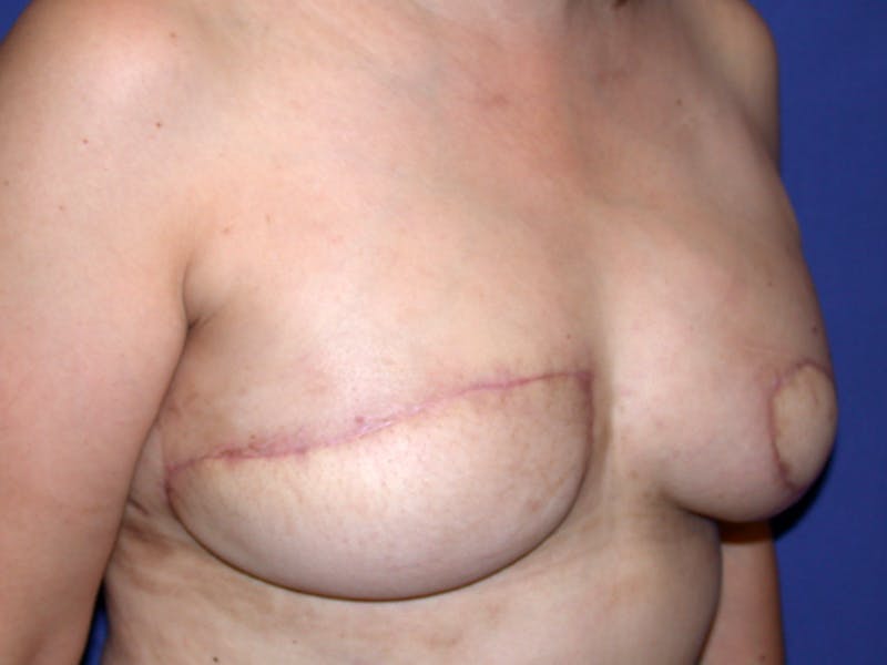 Nipple Reconstruction Before & After Gallery - Patient 212702 - Image 3
