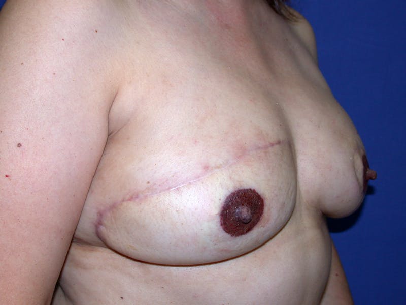 Nipple Reconstruction Before & After Gallery - Patient 212702 - Image 4
