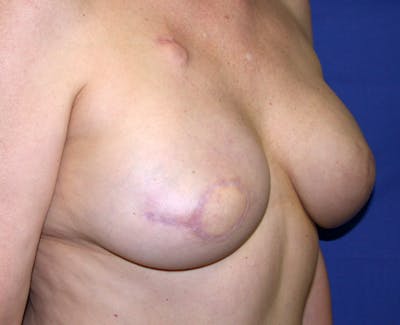 Nipple Reconstruction Before & After Gallery - Patient 173079 - Image 1