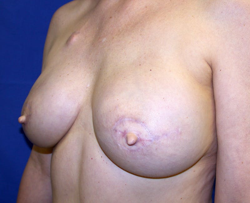 Nipple Reconstruction Before & After Gallery - Patient 173079 - Image 4