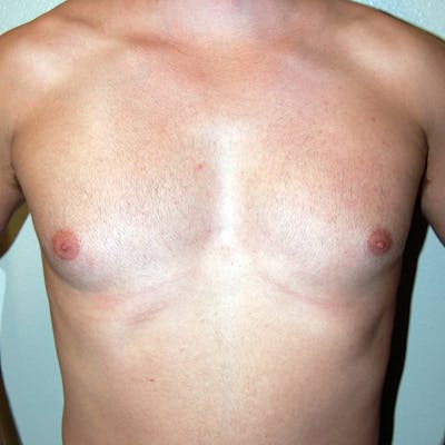 Gynecomastia Before & After Gallery - Patient 343172 - Image 1