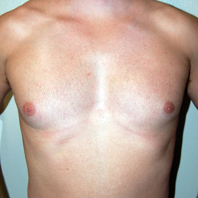 Gynecomastia Before & After Gallery - Patient 343172 - Image 1