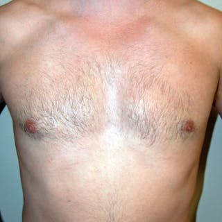Gynecomastia Before & After Gallery - Patient 343172 - Image 2