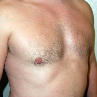 Gynecomastia Before & After Gallery - Patient 343172 - Image 4