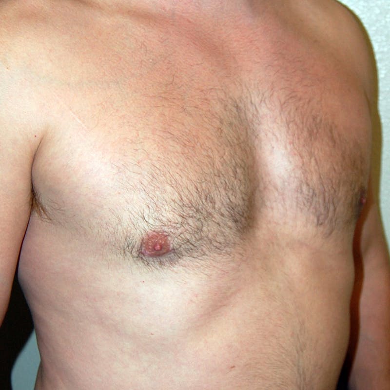 Gynecomastia Before & After Gallery - Patient 343172 - Image 4