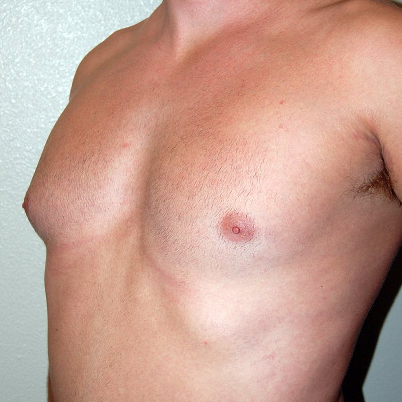 Gynecomastia Before & After Gallery - Patient 343172 - Image 5
