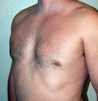 Gynecomastia Before & After Gallery - Patient 343172 - Image 6