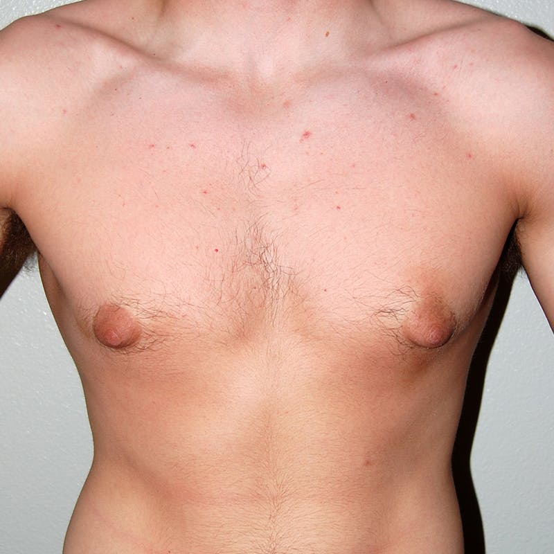 Gynecomastia Before & After Gallery - Patient 262720 - Image 1
