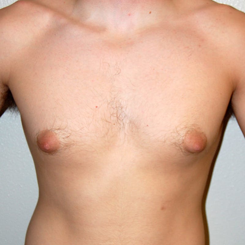 Gynecomastia Before & After Gallery - Patient 262720 - Image 2