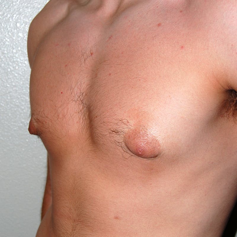 Gynecomastia Before & After Gallery - Patient 262720 - Image 4