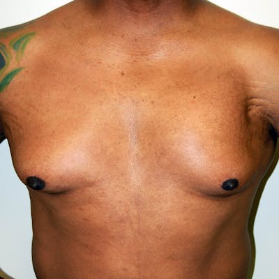 Gynecomastia Before & After Gallery - Patient 414772 - Image 1