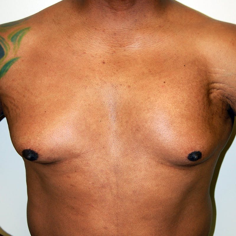 Gynecomastia Before & After Gallery - Patient 414772 - Image 1