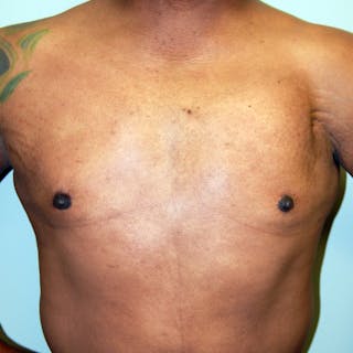 Gynecomastia Before & After Gallery - Patient 414772 - Image 2