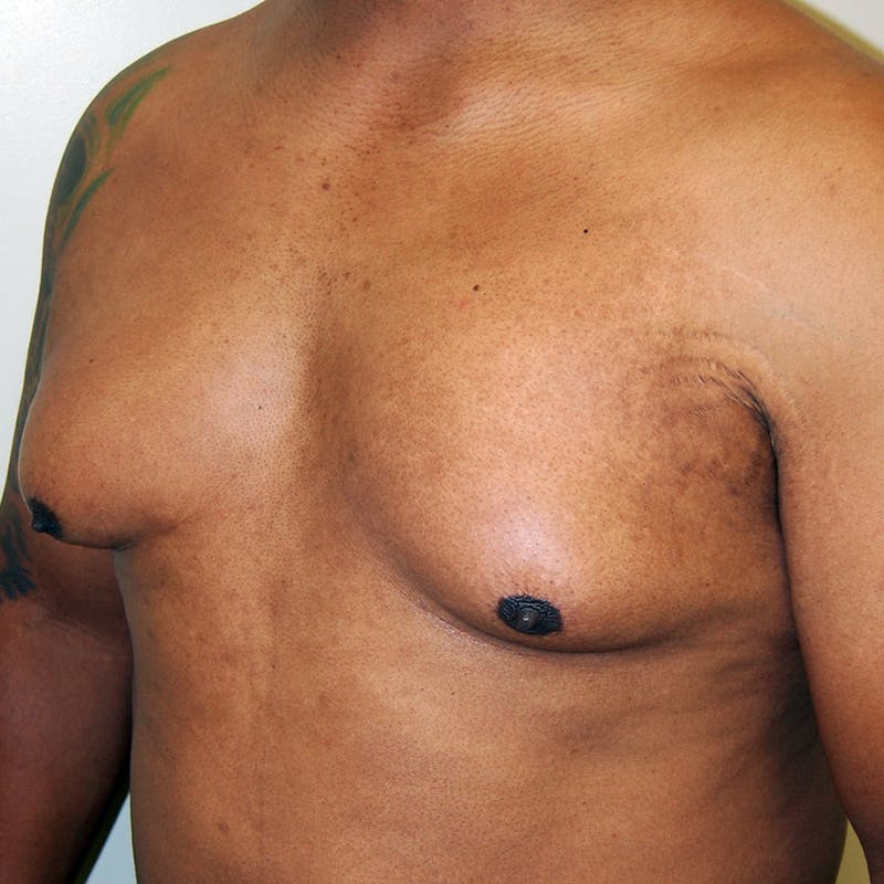 Gynecomastia Before & After Gallery - Patient 414772 - Image 3