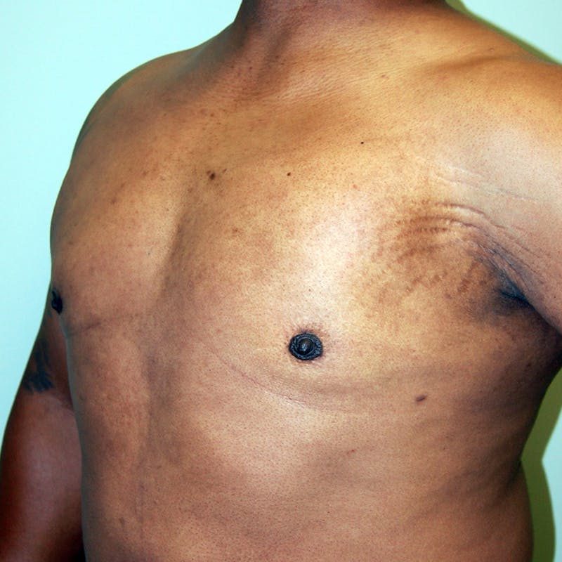 Gynecomastia Before & After Gallery - Patient 414772 - Image 4
