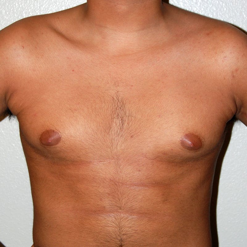 Gynecomastia Before & After Gallery - Patient 116345 - Image 1