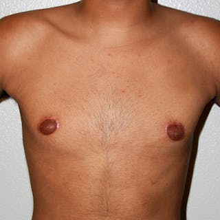 Gynecomastia Before & After Gallery - Patient 116345 - Image 2