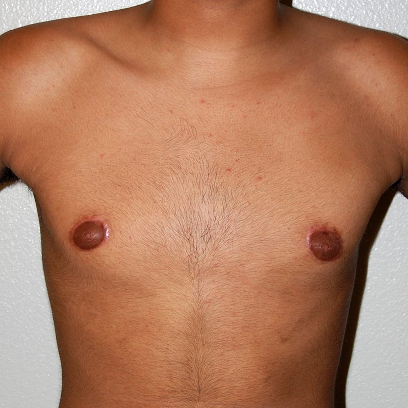 Gynecomastia Before & After Gallery - Patient 116345 - Image 2