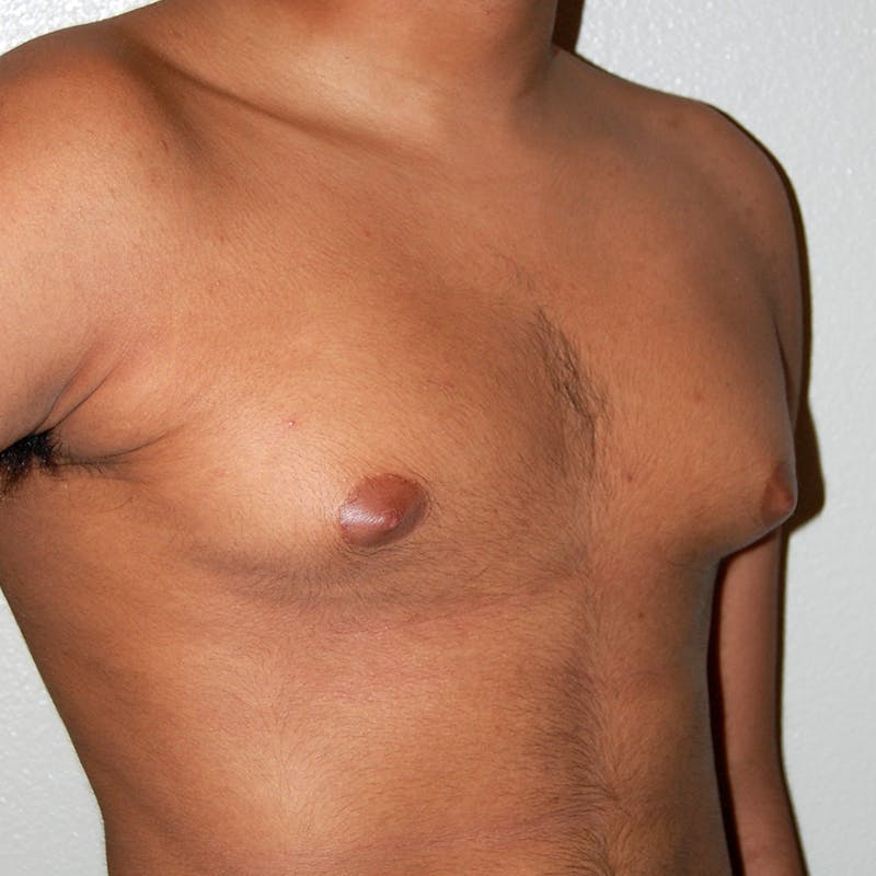 Gynecomastia Before & After Gallery - Patient 116345 - Image 3