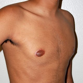Gynecomastia Before & After Gallery - Patient 116345 - Image 4