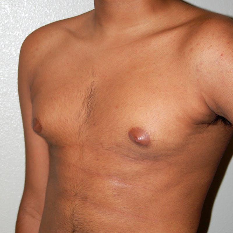 Gynecomastia Before & After Gallery - Patient 116345 - Image 5
