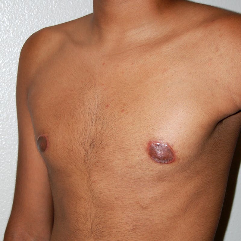 Gynecomastia Before & After Gallery - Patient 116345 - Image 6
